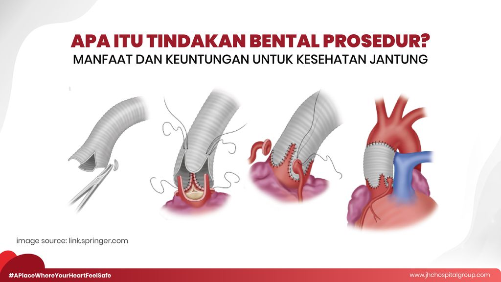 Apa itu tindakan Bental Prosedur? Manfaat dan Keuntungan Untuk Kesehatan Jantung